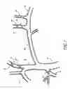 Fig. 02 - METHODS AND APPARATUS FOR TREATING NEUROVASCULAR VENOUS OUTFLOW OBSTRUCTION