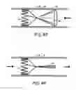 Fig. 05 - METHODS AND APPARATUS FOR TREATING NEUROVASCULAR VENOUS OUTFLOW OBSTRUCTION