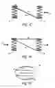 Fig. 07 - METHODS AND APPARATUS FOR TREATING NEUROVASCULAR VENOUS OUTFLOW OBSTRUCTION