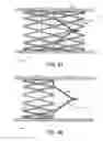 Fig. 08 - METHODS AND APPARATUS FOR TREATING NEUROVASCULAR VENOUS OUTFLOW OBSTRUCTION