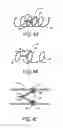 Fig. 09 - METHODS AND APPARATUS FOR TREATING NEUROVASCULAR VENOUS OUTFLOW OBSTRUCTION