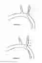 Fig. 22 - METHODS AND APPARATUS FOR TREATING NEUROVASCULAR VENOUS OUTFLOW OBSTRUCTION