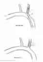 Fig. 23 - METHODS AND APPARATUS FOR TREATING NEUROVASCULAR VENOUS OUTFLOW OBSTRUCTION