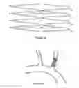 Fig. 25 - METHODS AND APPARATUS FOR TREATING NEUROVASCULAR VENOUS OUTFLOW OBSTRUCTION