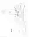 Fig. 02 - Lower limb prosthesis