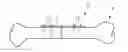Fig. 01 - Method to determine a parameter of a fixing element for an implant to be affixed to a bone
