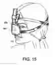 Fig. 16 - Cushion assembly for a respiratory mask