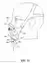 Fig. 35 - Patient interface assembly with conduits on each side of the head