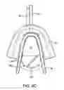 Fig. 07 - Methods and systems for improving airway patency