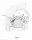 Fig. 02 - Methods and systems for saliva management with an oral device