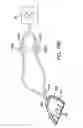Fig. 32 - Methods and systems for saliva management with an oral device