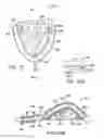 Fig. 35 - Methods and systems for saliva management with an oral device