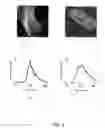 Fig. 04 - Spatio-temporal analysis for automatic contrast injection detection on angiography during trans-catheter aortic valve implantation