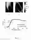 Fig. 05 - Spatio-temporal analysis for automatic contrast injection detection on angiography during trans-catheter aortic valve implantation