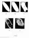 Fig. 06 - Spatio-temporal analysis for automatic contrast injection detection on angiography during trans-catheter aortic valve implantation