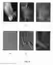Fig. 10 - Spatio-temporal analysis for automatic contrast injection detection on angiography during trans-catheter aortic valve implantation