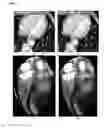 Fig. 07 - Method and system for heart isolation in cardiac computed tomography volumes for patients with coronary artery bypasses
