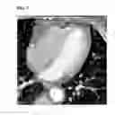 Fig. 08 - Method and system for heart isolation in cardiac computed tomography volumes for patients with coronary artery bypasses