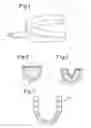 Fig. 02 - Method and Impression Tray for Producing a Dental Mold