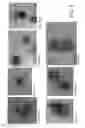 Fig. 08 - METHODS AND MATERIALS FOR DIAGNOSING LIGHT CHAIN AMYLOIDOSIS