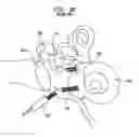 Fig. 03 - HEARING PROSTHESIS HAVING A FLEXIBLE ELONGATE ENERGY TRANSFER MECHANISM
