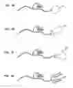 Fig. 06 - HEARING PROSTHESIS HAVING A FLEXIBLE ELONGATE ENERGY TRANSFER MECHANISM