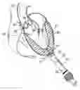 Fig. 01 - Surgical stabilizer and closure system