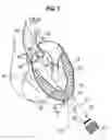 Fig. 08 - Surgical stabilizer and closure system
