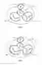 Fig. 04 - Method and apparatus for external stabilization of the heart
