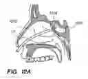 Fig. 12 - Endoscopic methods and devices for transnasal procedures