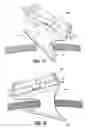 Fig. 09 - Surgical hand access apparatus