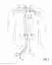Fig. 04 - Methods of Transvascular Retrograde Access Placement and Devices for Facilitating the Placement