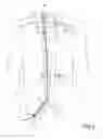 Fig. 05 - Methods of Transvascular Retrograde Access Placement and Devices for Facilitating the Placement