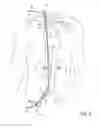 Fig. 06 - Methods of Transvascular Retrograde Access Placement and Devices for Facilitating the Placement