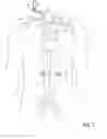 Fig. 08 - Methods of Transvascular Retrograde Access Placement and Devices for Facilitating the Placement