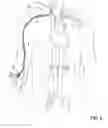 Fig. 09 - Methods of Transvascular Retrograde Access Placement and Devices for Facilitating the Placement