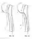 Fig. 20 - Methods of Transvascular Retrograde Access Placement and Devices for Facilitating the Placement