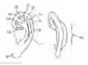 Fig. 01 - Correcting misshaped ears
