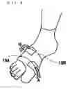 Fig. 09 - SUPPORT FOR FOOT INJURIES