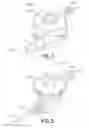 Fig. 03 - Integrated spring-activated ballistic insertion for drug infusion device