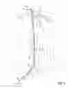 Fig. 06 - Methods of transvascular retrograde access placement and devices for facilitating the placement