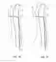 Fig. 11 - Methods of transvascular retrograde access placement and devices for facilitating the placement