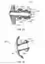Fig. 33 - Ostomy containment device