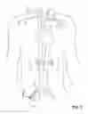 Fig. 03 - Methods of transvascular retrograde access placement and devices for facilitating therein