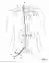Fig. 05 - Methods of transvascular retrograde access placement and devices for facilitating therein