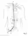 Fig. 06 - Methods of transvascular retrograde access placement and devices for facilitating therein