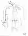 Fig. 09 - Methods of transvascular retrograde access placement and devices for facilitating therein