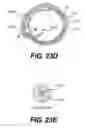 Fig. 33 - Endovascular devices and methods for exploiting intramural space