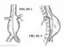 Fig. 08 - Fenestration devices, systems, and methods
