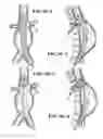 Fig. 09 - Fenestration devices, systems, and methods